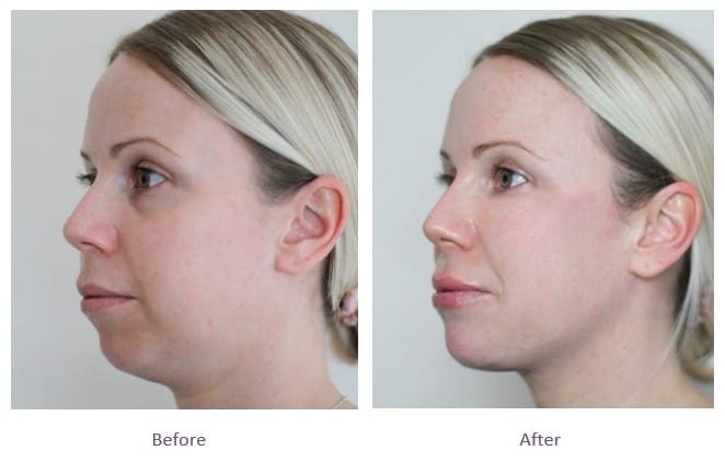 Chiseled Perfection: Jawline Fillers Treatment in Dubai