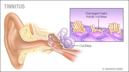 Tinnitus Cure in Pakistan