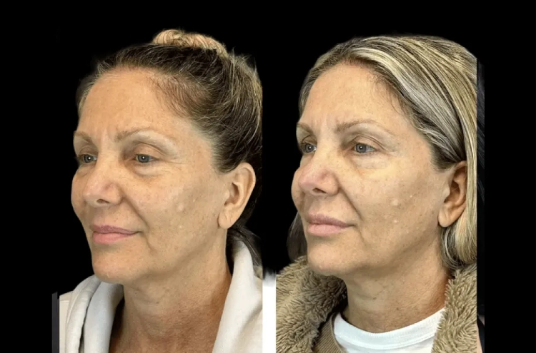 Top Botox Treatments Offered by the Best Plastic Surgeons in dubai